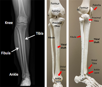 Broken Tibia (Picture Credits: Ota.org)