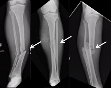 Broken Tibia