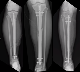 Broken Tibia Surgery